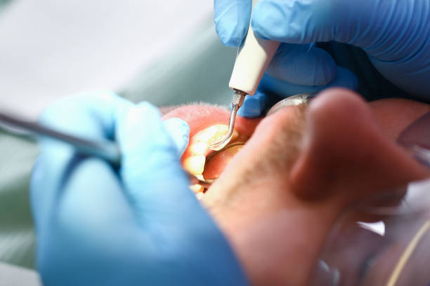 Best Emergency Tooth Extraction in Nisswa, MN